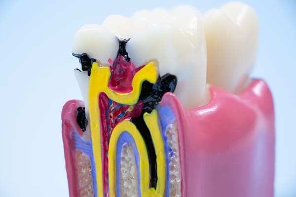 歯を削ることを最小限にしたMI虫歯治療