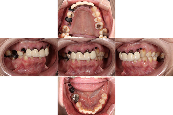 初診時の口腔内