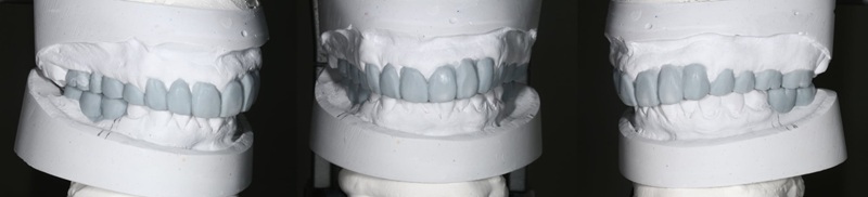 ワックスアップ