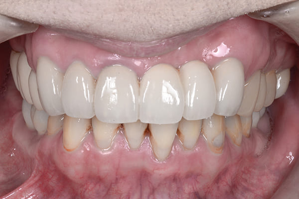 ボロボロの歯の治療後