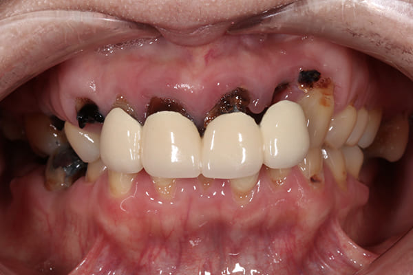 ボロボロの歯の治療前