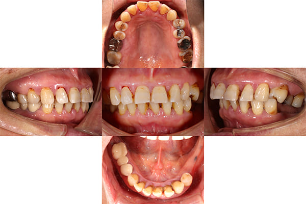 初診時の口腔内