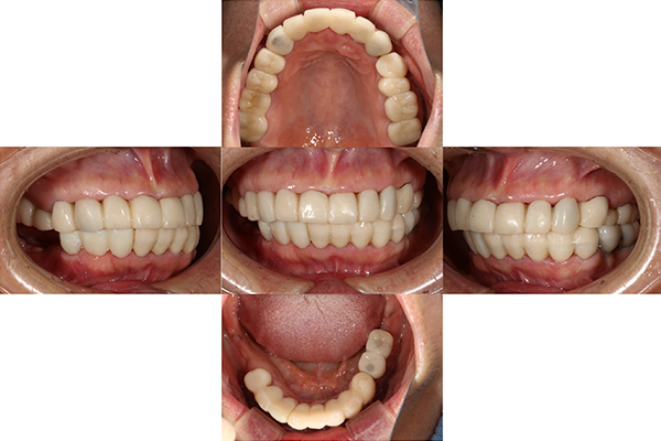 歯周基本治療後