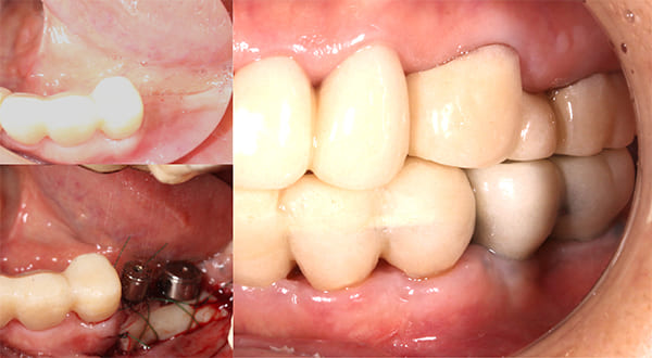 インプラント治療後（左側）
