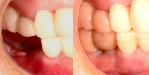 インプラント治療後（右側）