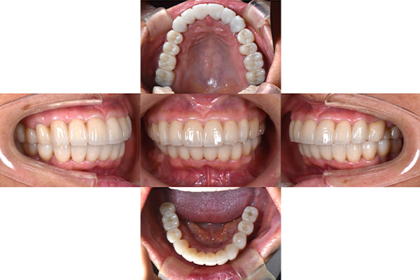 最終補綴物装着後