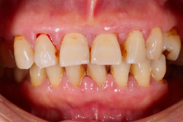 治療前の口腔内