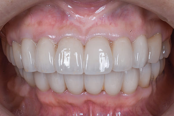 治療後の口腔内