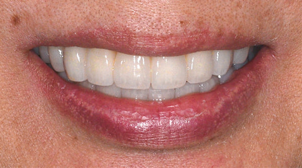 歯ぐきから血が出る治療後