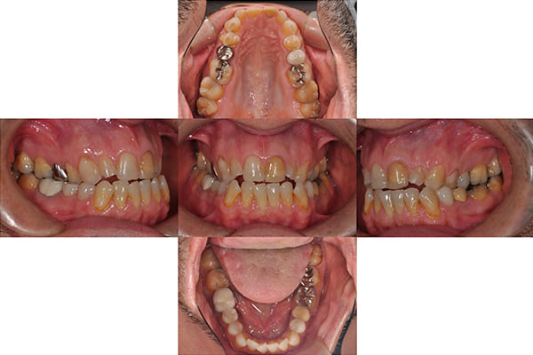 初診時の口腔内
