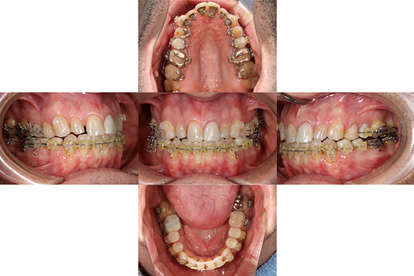 噛み合わせの改善