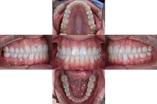 最終補綴物装着後