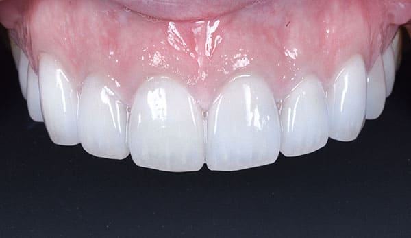 セラミック治療後 正面