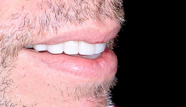 セラミック治療後 顔貌