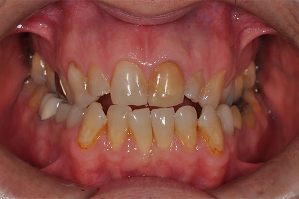 治療前の口腔内