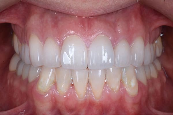 治療後の口腔内
