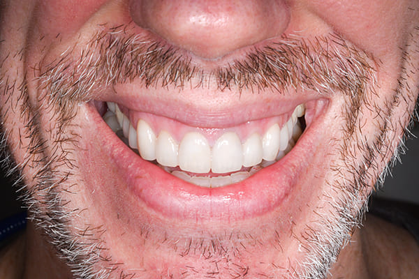 スマイル時の見た目の改善 治療後