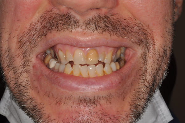 スマイル時の見た目の改善 治療前