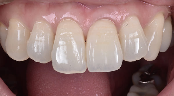 左前歯の1番単独歯 治療後