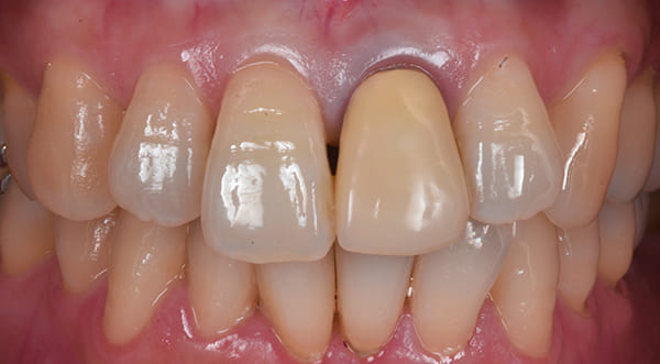 左前歯の1番単独歯 治療前