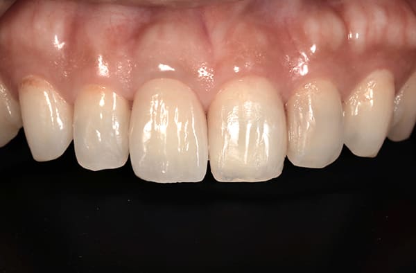 右前歯の1番単独歯 治療後