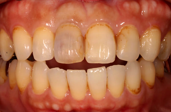 右前歯の1番単独歯 治療前