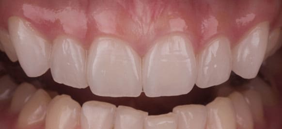 上顎左右犬歯～犬歯 治療後