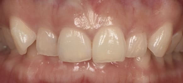 上顎左右犬歯～犬歯 治療前