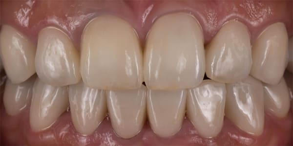 上顎左右犬歯～犬歯・下顎左右小臼歯～小臼歯 治療後
