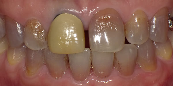 上顎左右犬歯～犬歯・下顎左右小臼歯～小臼歯 治療前