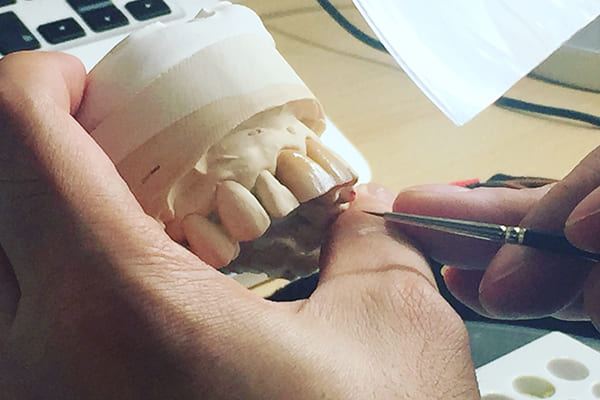 匠なテクニシャンによるセラミック補綴