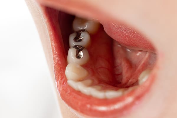 金属や銀歯が全身にもたらす影響