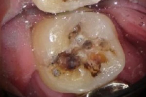 カリエスリスク