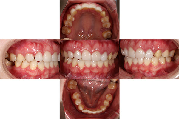 初診時の口腔内