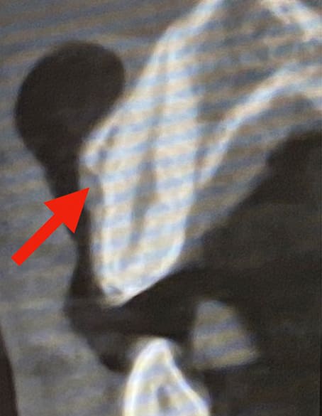 初診時のCT画像