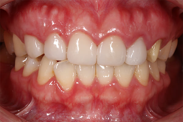 歯周外科手術前