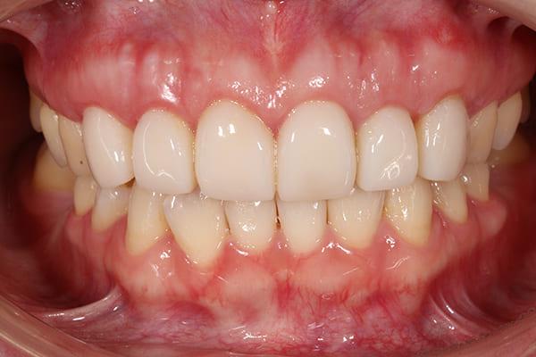 歯周外科手術後