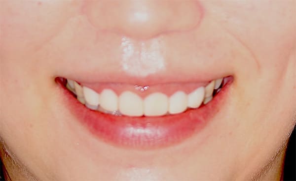スマイル時の治療前の口元