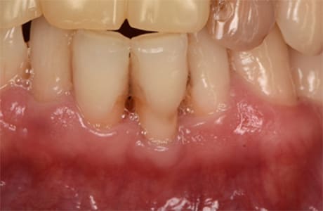 結合組織移植術治療前