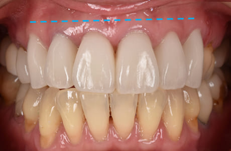 歯肉形成治療後