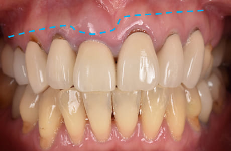 歯肉形成治療前