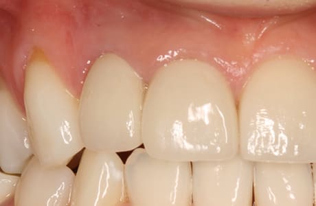 補綴物による歯ぐきの黒ずみ除去治療後