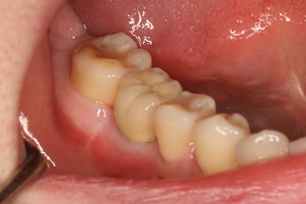 臼歯部（奥歯）の単独欠損治療後