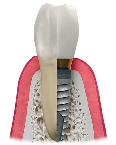 安心と安全を追求した一生もののインプラント