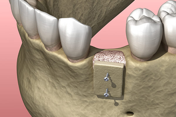 ボーングラフト法