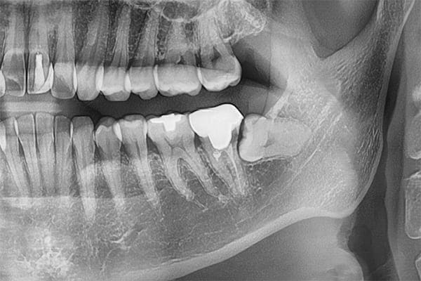 埋伏歯の抜歯ケース治療前