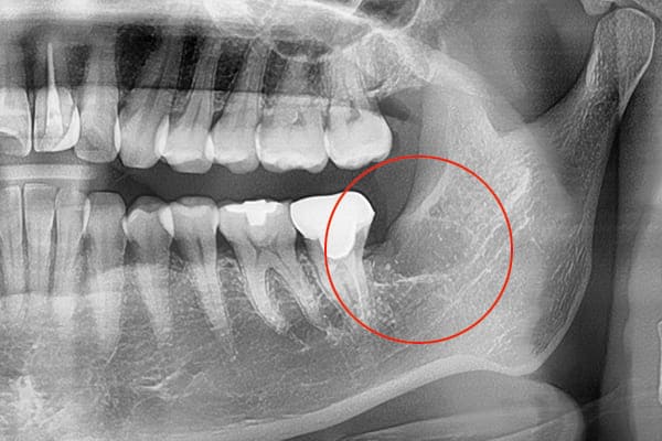 埋伏歯の抜歯ケース治療後