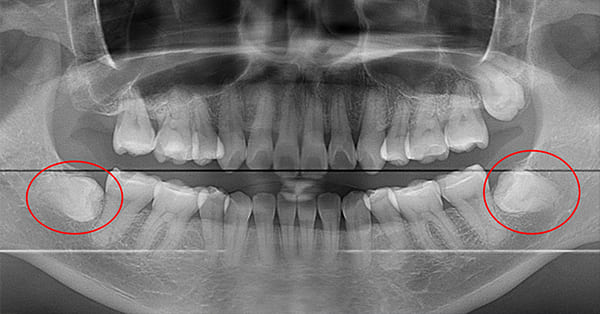 パノラマレントゲン