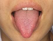 口腔がんの約半数は舌にできます