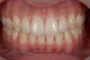 開咬・オープンバイト 治療後正面